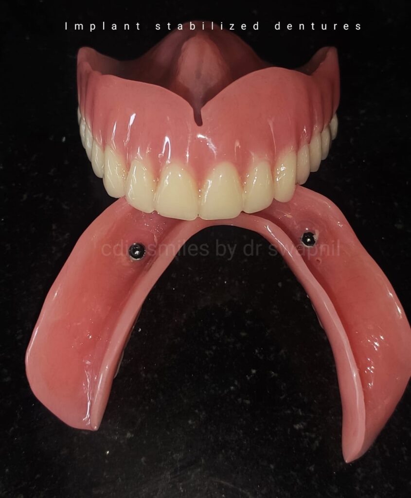 Implant Dentures1