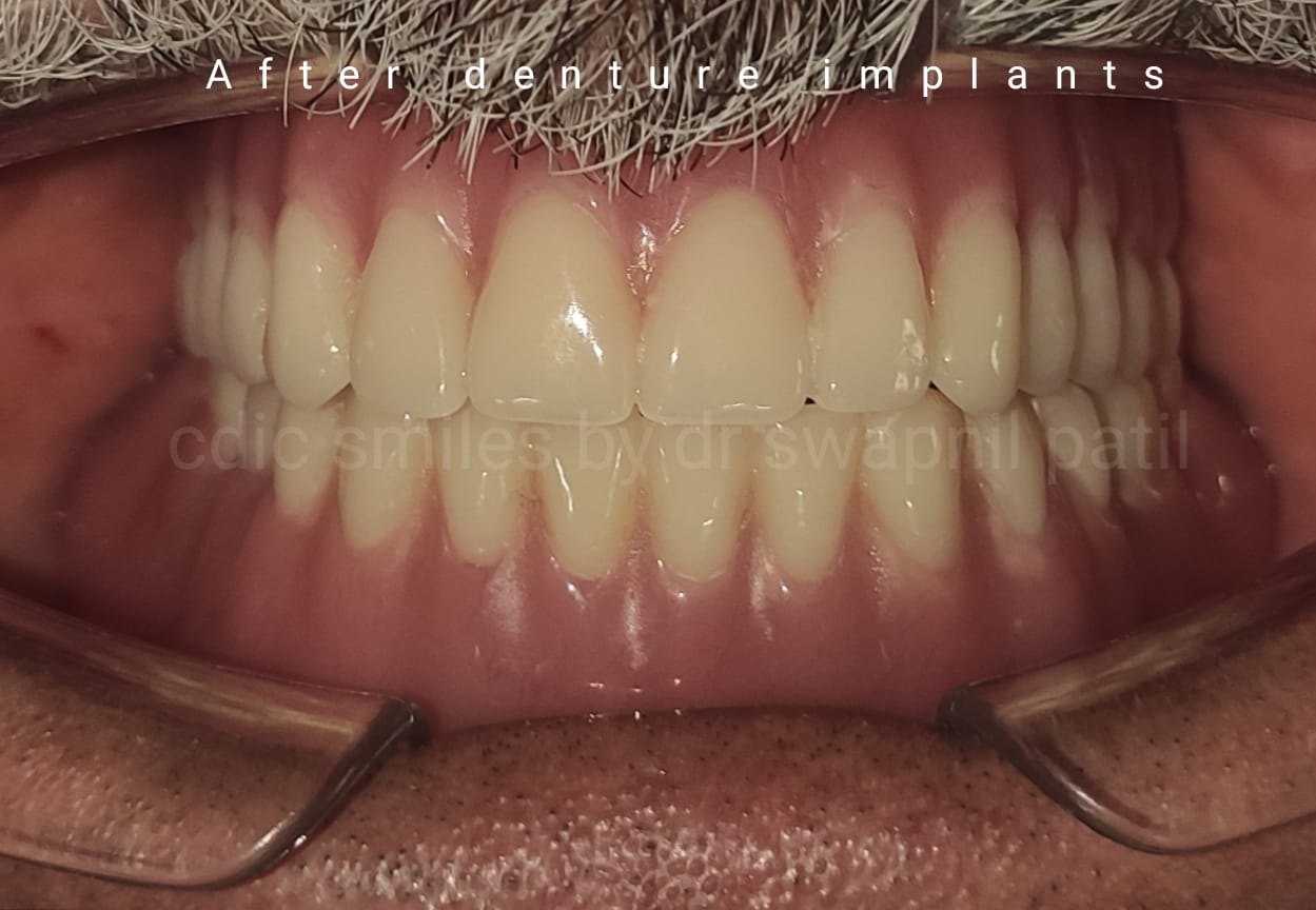 Implant Dentures2