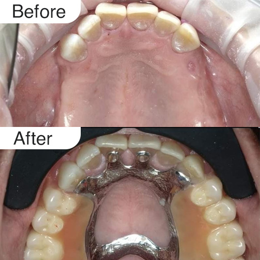 Partial Denture