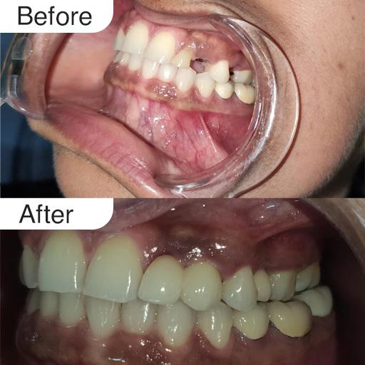 dental implant need to straighten