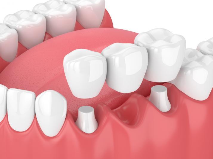 dental-crowns-and-bridges