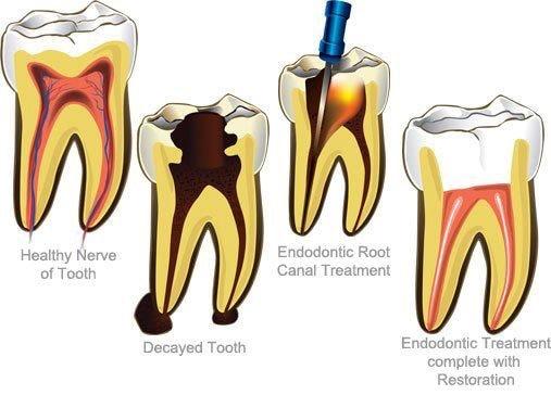 Root Canal Treatment/ single visit RCT