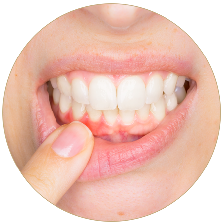 Rejuvenation of the Gums