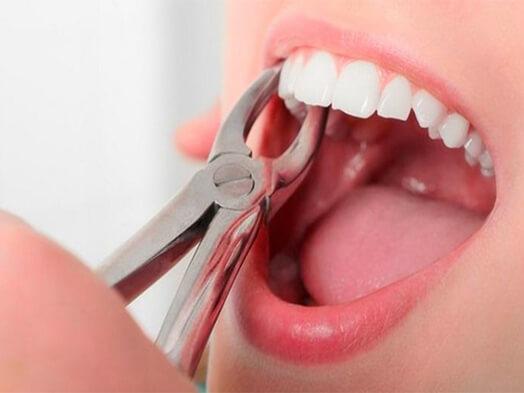 painless-tooth-extraction-ahmedabad